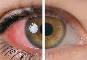 Eye Inflammation Can Be Effectively Treated with Prednisolone Ophthalmic